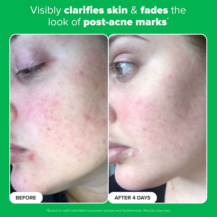 10% Azelaic Acid Booster 30ml - GLAM MODA