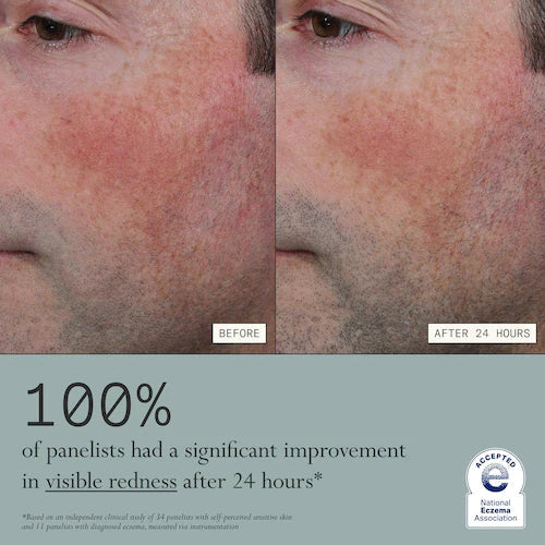 Skin Mercy Intense Recovery Cream for Sensitive & Eczema-Prone Skin - GLAM MODA