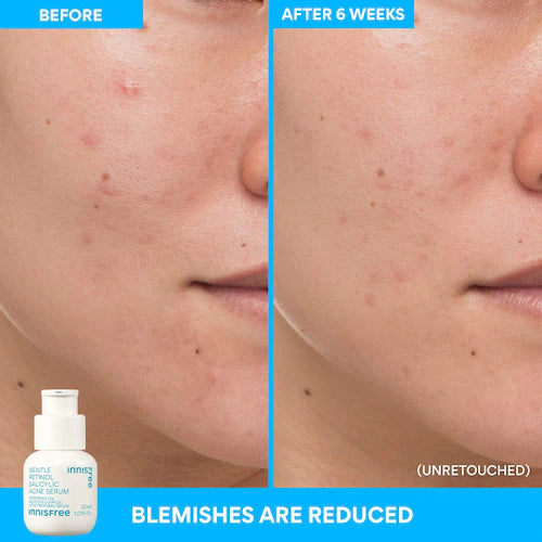 Gentle Retinol Salicylic Acne Serum - GLAM MODA