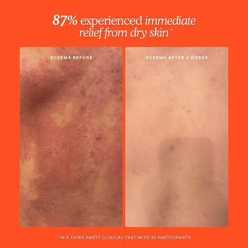 SOS Daily Hypochlorous Acid Spray for Breakouts & Redness - GLAM MODA