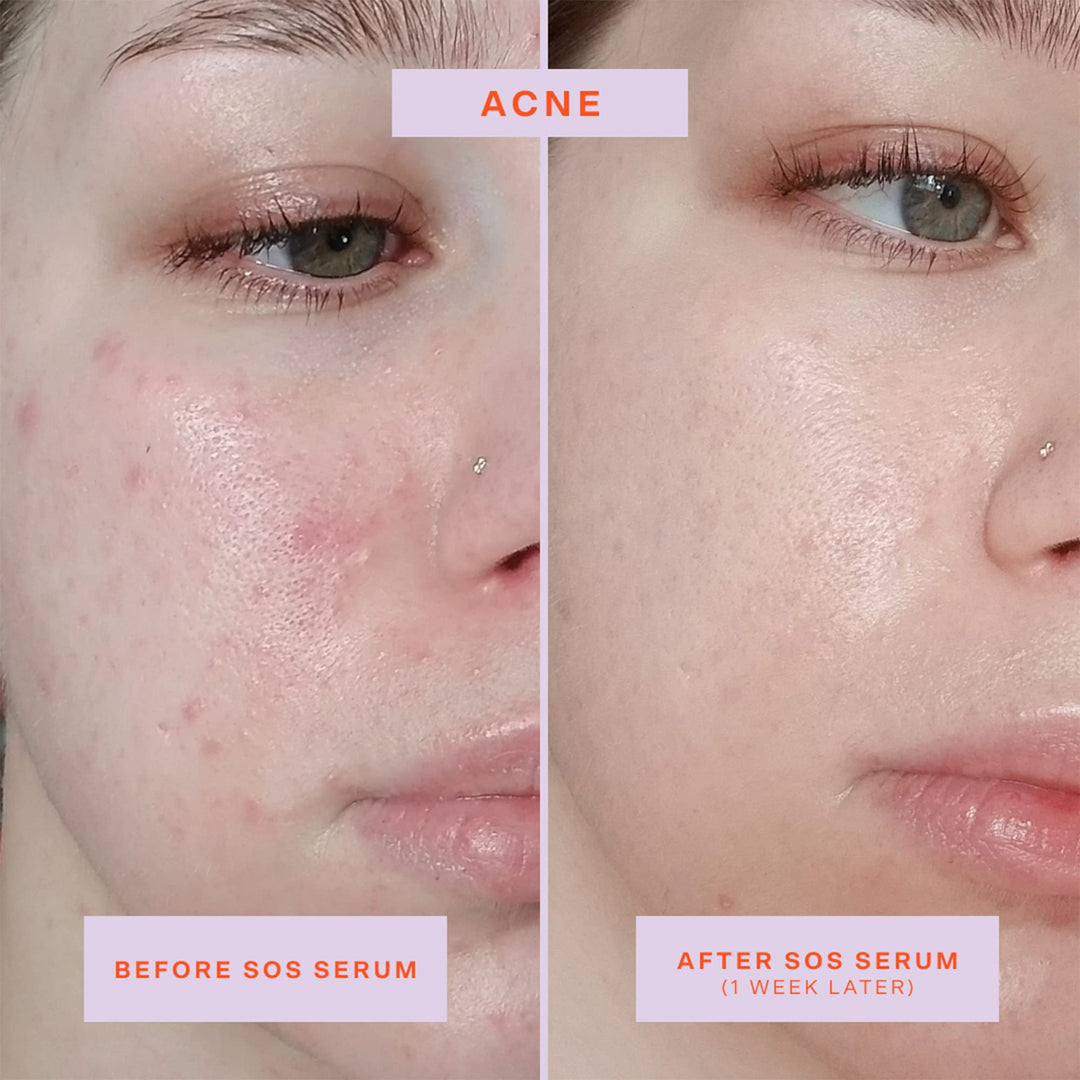 SOS Intensive Redness Relief Serum with Hypochlorous Acid - GLAM MODA