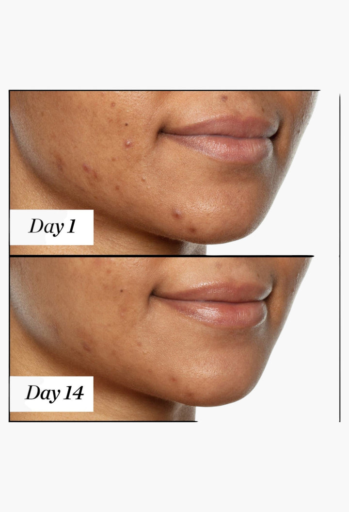 U.F.O. Ultra-Clarifying Acne Treatment Face Oil