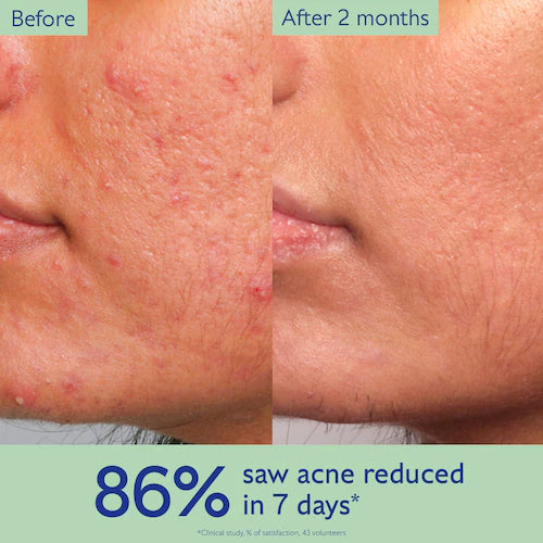Vinopure Acne-Prone Skin Essentials - GLAM MODA