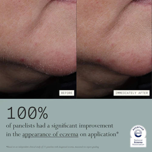 Skin Mercy Intense Recovery Cream for Sensitive & Eczema-Prone Skin - GLAM MODA