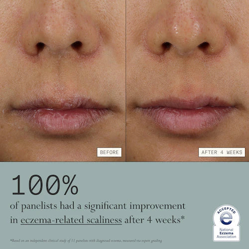 Skin Mercy Intense Recovery Cream for Sensitive & Eczema-Prone Skin - GLAM MODA