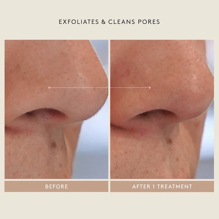 Mini Triple Acid Signature Peel - GLAM MODA