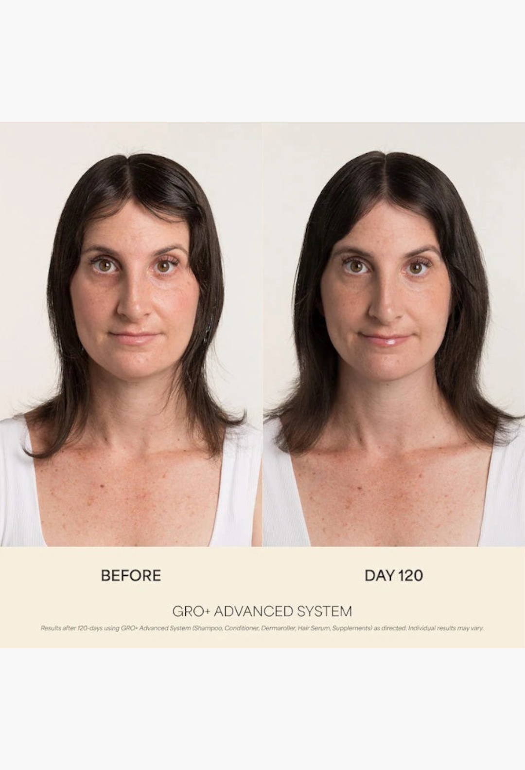 GLAM MODA before and after results of using GRO+ Advanced hair thinning treatment showing increased hair density