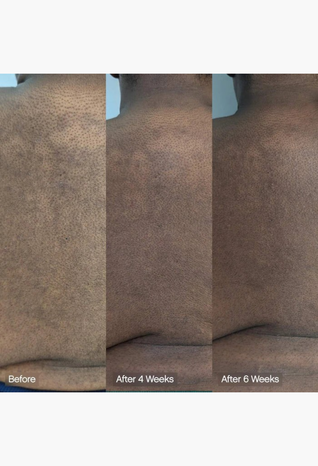 GLAM MODA before and after results of brightening body bar showing reduced dark spots and even skin tone over 6 weeks
