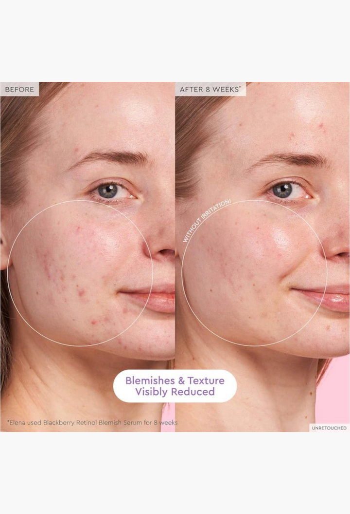 GLAM MODA before and after comparison showing reduced blemishes and smoother skin texture after 8 weeks of treatment.