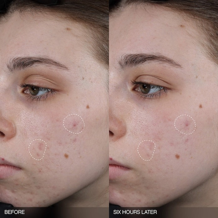 Faded Tranexamic Acid Dark Spot Patches for Hyperpigmentation - GLAM MODA