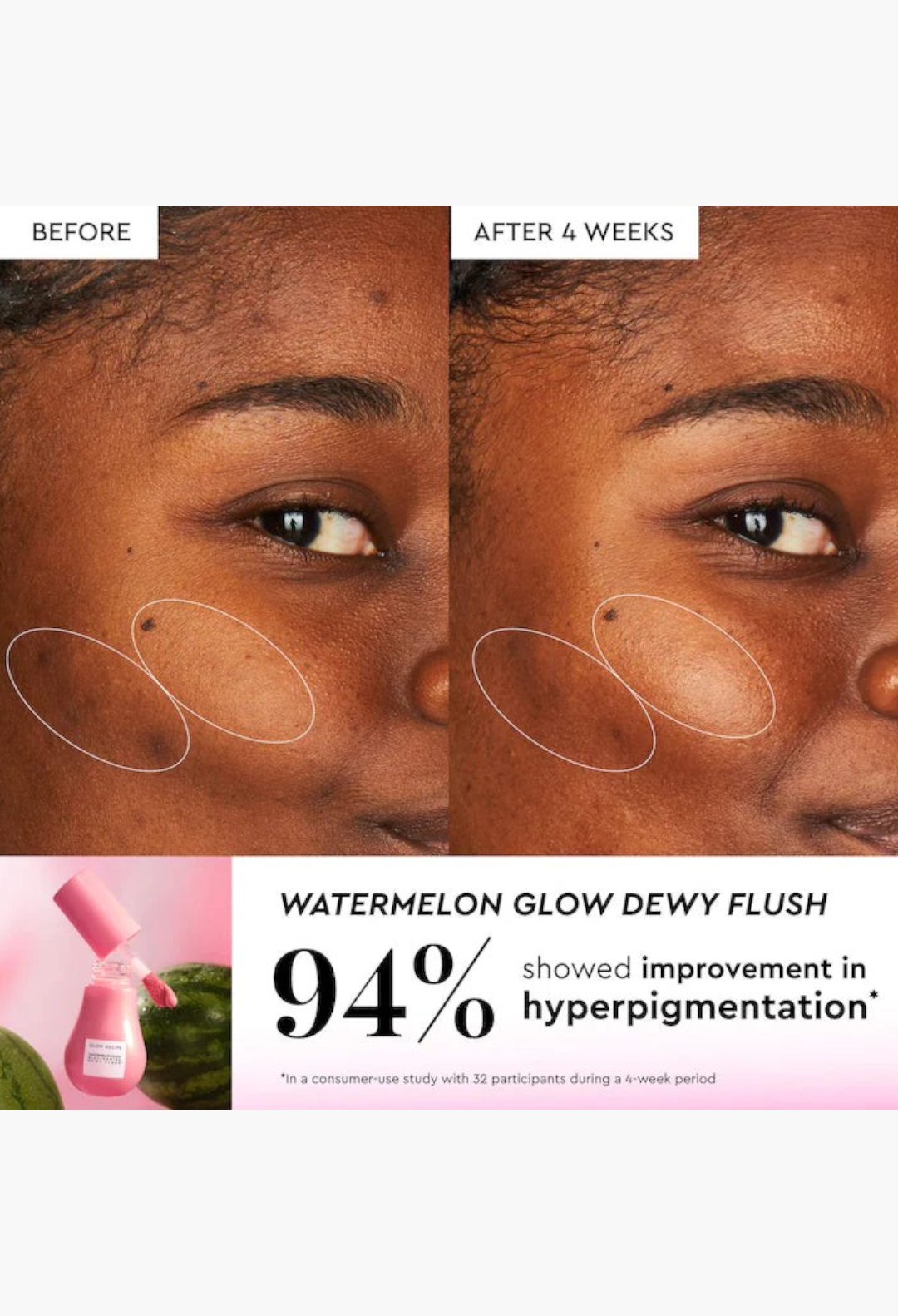GLAM MODA before and after results of Watermelon Glow Dewy Flush showing reduced hyperpigmentation on a model's cheek