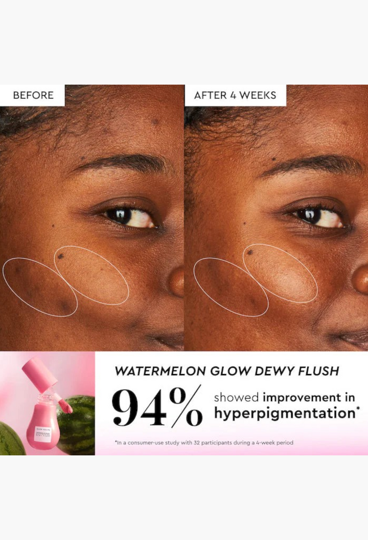 GLAM MODA before and after results of Watermelon Glow Dewy Flush showing reduced hyperpigmentation on a model's cheek